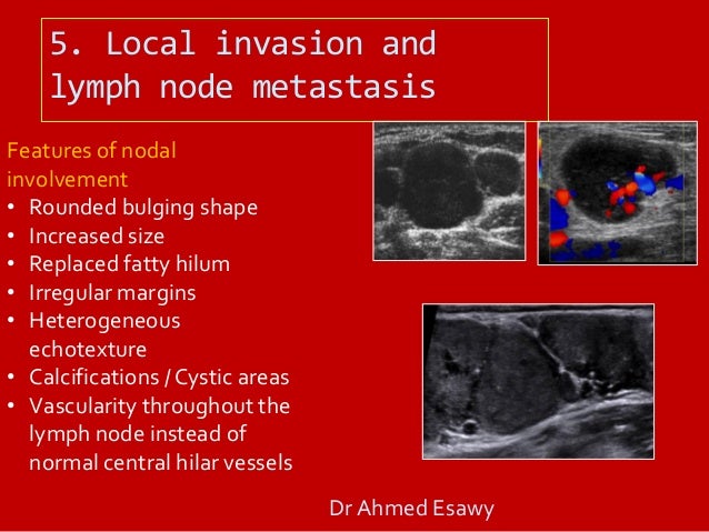 Loss of fatty hilum in cervical lymph nodes Loss of fatty hilum in cervical lymph nodes